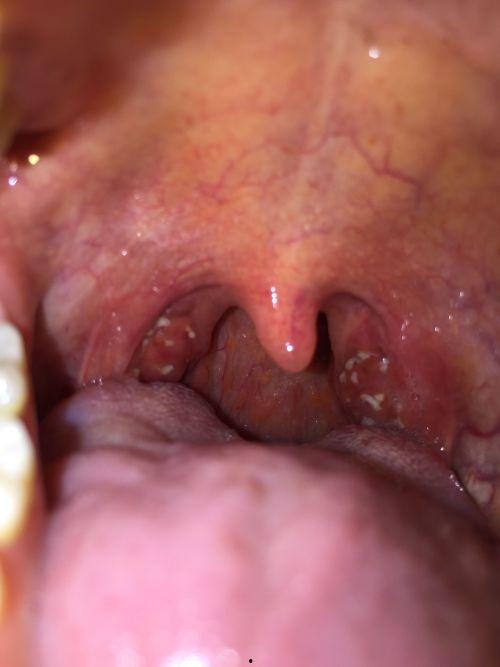 吃小瓜喉咙痒,揭秘吃小瓜引发的痒感之谜